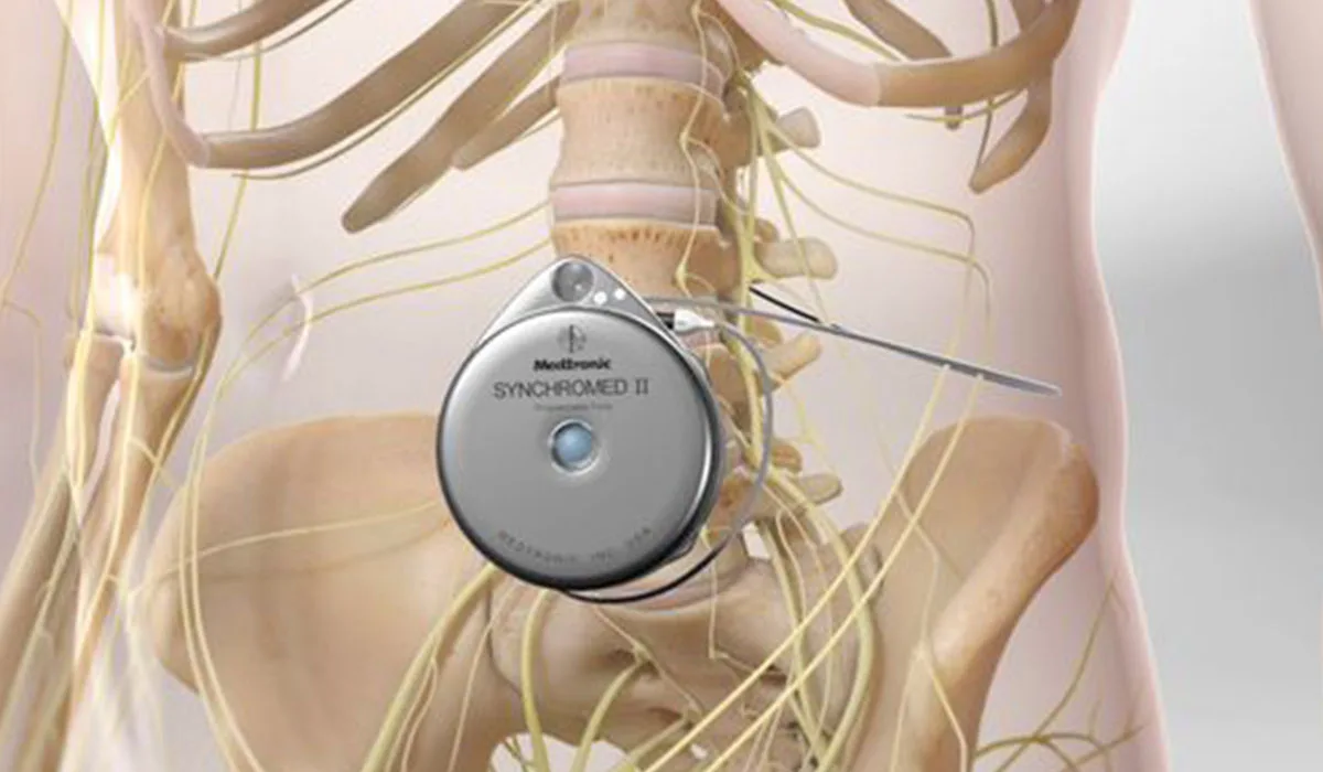 Intrathecal Drug Delivery System Pain Management in Ahmedabad