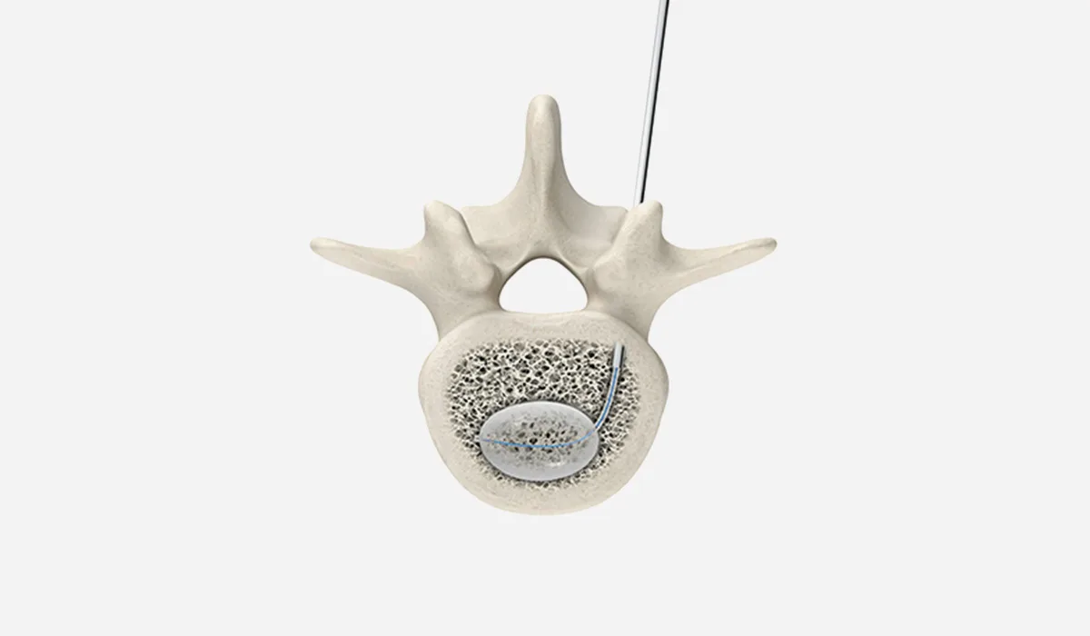vertebroplasty treatment