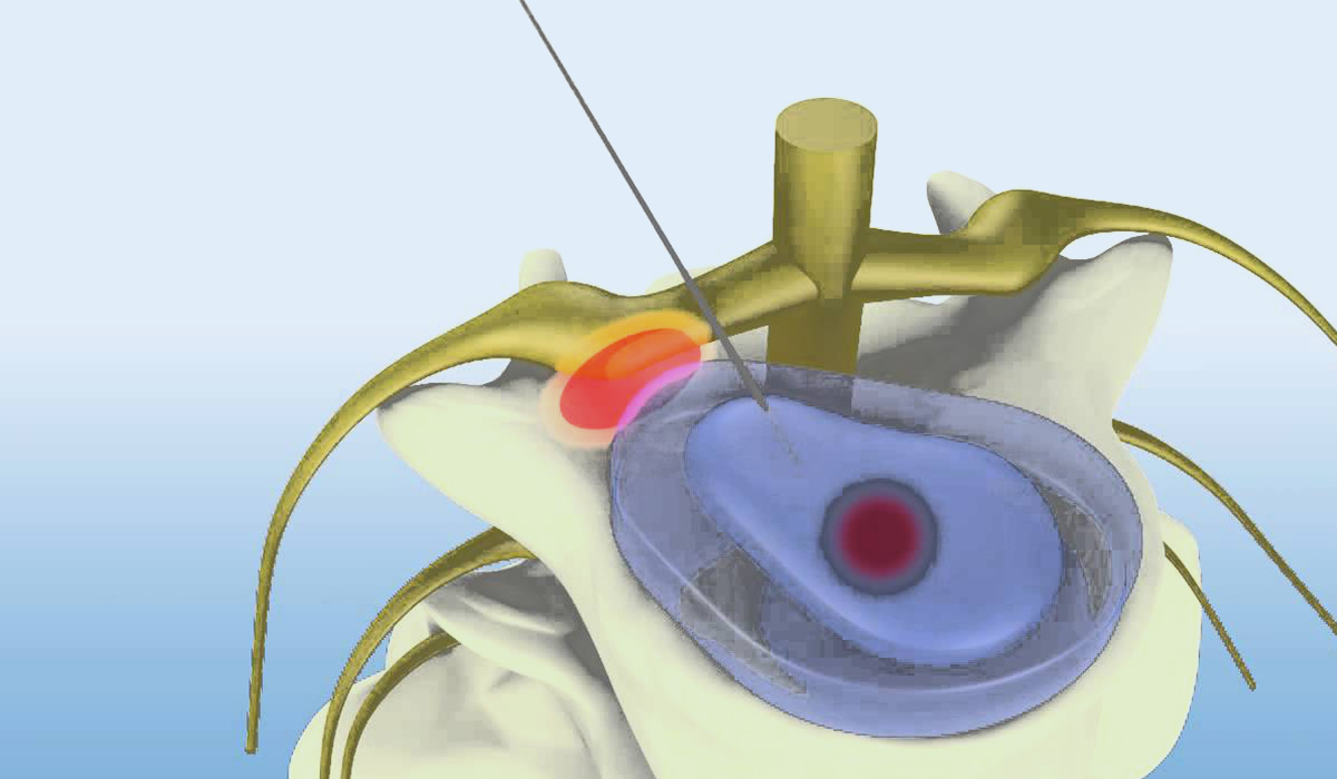 Advanced LASER Therapy (PLDD) in Ahmedabad