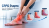CRPS stages showing how complex regional pain syndrome symptoms may progress over time
